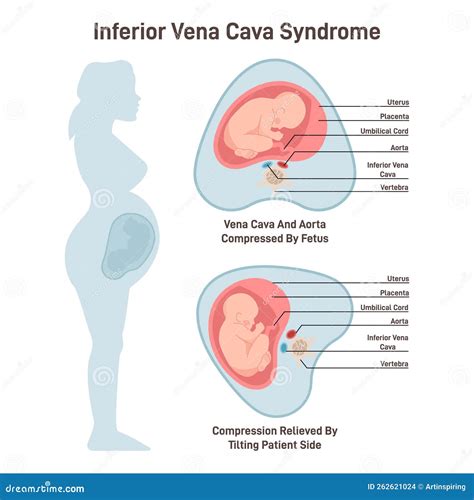 Diagramma della compressione della vena cava in posizione supina