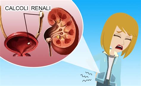 Illustrazione di calcoli renali e vie urinarie