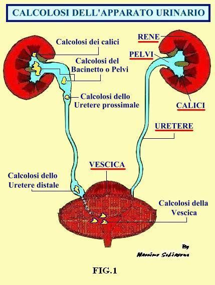 illustrazione anatomica del sistema urinario con evidenza di un calcolo nell'uretere