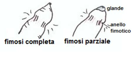 Rappresentazione della fimosi fisiologica e prepuzio retraibile