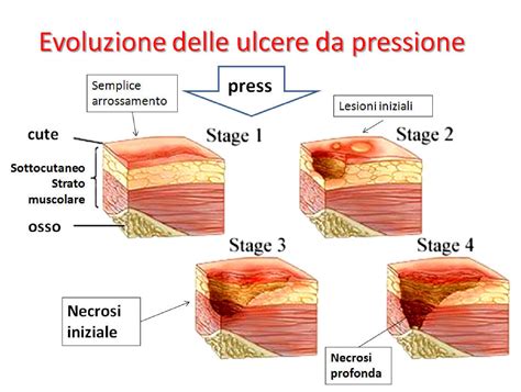 Illustrazione di diversi gradi di lacerazione perineale