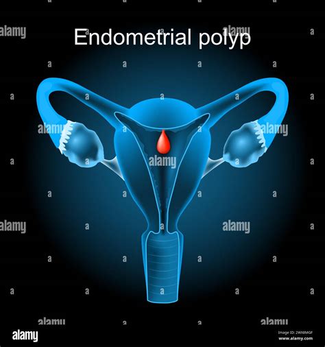 Infografica sui sintomi comuni dei polipi uterini