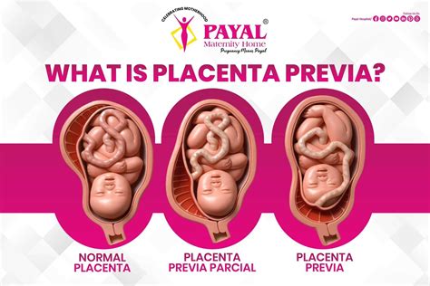 Illustrazione anatomica dell'utero con placenta previa centrale