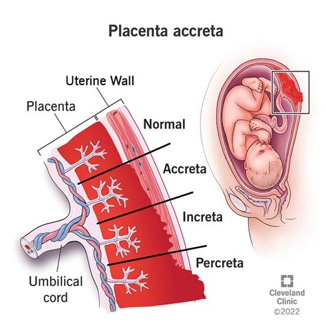 Illustrazione della placenta accreta