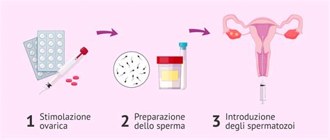 Schema dell'inseminazione artificiale intrauterina (IUI)