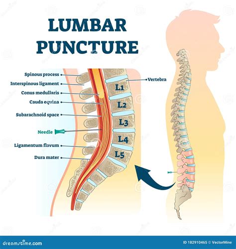 Puntura lombare diagnostica