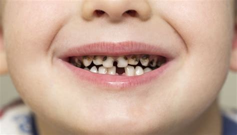 Denti di un bambino con carie da biberon