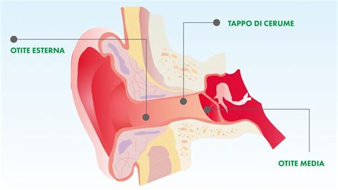 Tipi di otite in base alla localizzazione