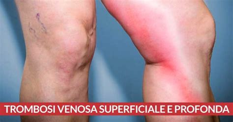 Sintomi comuni di trombosi agli arti inferiori