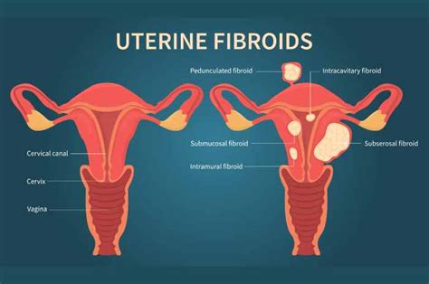 Diagramma che illustra i diversi tipi di fibromi uterini