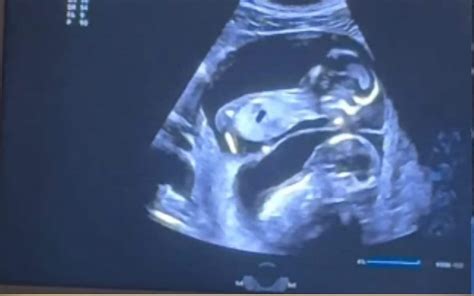 Immagine di un'ecografia che mostra due gemelli in utero
