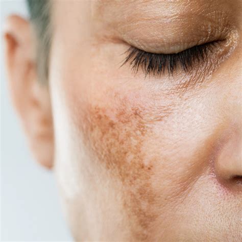 Macchie gravidiche sul viso e sulla pancia (melasma e linea nigra)