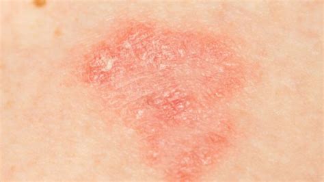 Pelle secca e irritata con placche eritematose da dermatite atopica