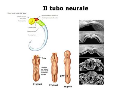 illustrazione schematica dei difetti del tubo neurale e del passaggio di AFP