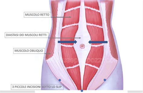 schema anatomico della parete addominale con evidenza della linea alba e dei muscoli retti