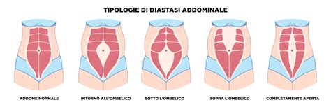 infografica che illustra i cambiamenti della parete addominale durante i trimestri di gravidanza