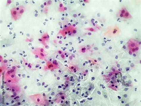 Effetti della gardnerella sulla gravidanza