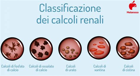 Tipi di calcoli renali e loro composizione