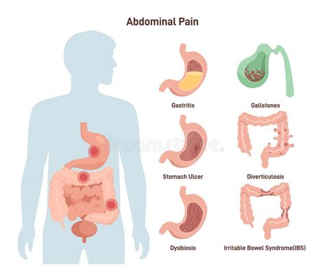 Illustrazione delle diverse patologie addominali in gravidanza