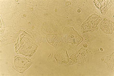 Microscopio che analizza un campione di urina con cellule epiteliali