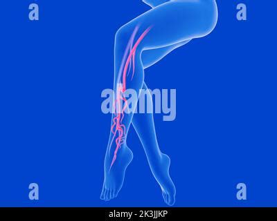 Illustrazione del sistema venoso pelvico e delle gambe con utero in gravidanza che comprime i vasi