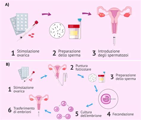 Illustrazione della procedura ICSI