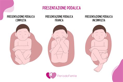 Schema che illustra le diverse posizioni fetali e la presentazione podalica