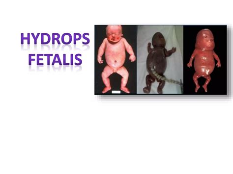 Illustration of a fetus with hydrops fetalis