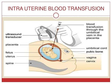 Diagram of intravascular intrauterine transfusion