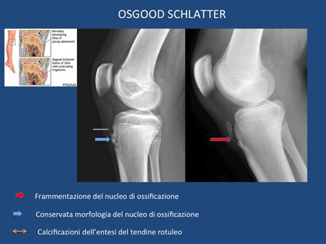 Radiografia di un ginocchio con sindrome di Osgood-Schlatter
