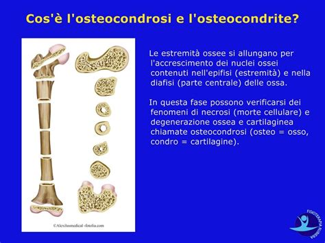 Mappa delle localizzazioni di osteocondrosi nei bambini