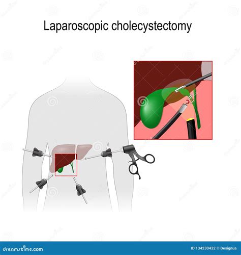 Illustrazione di una procedura laparoscopica