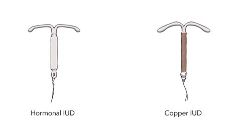 rappresentazione anatomica di uno IUD correttamente posizionato nell'utero
