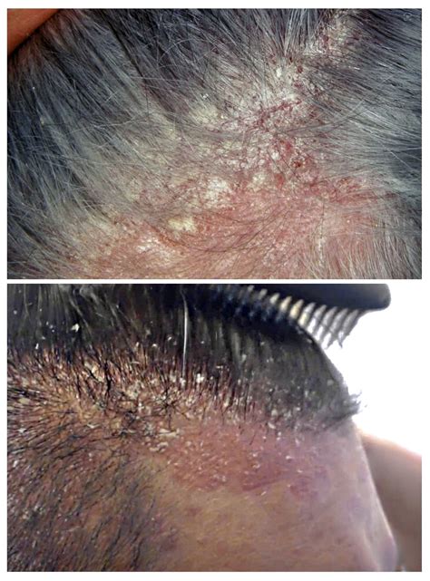 Bambino con dermatite seborroica sul cuoio capelluto