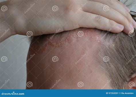 Bambino con eczema sul cuoio capelluto