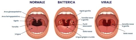 Diagramma che illustra la differenza tra tonsillite virale e batterica