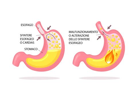 Stomaco Neonato e Valvola Gastroesofagea Immatura