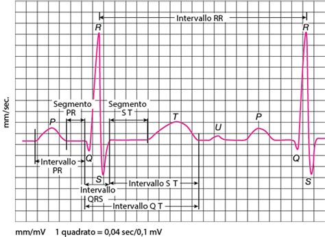 Elettrocardiogramma con intervallo QT evidenziato