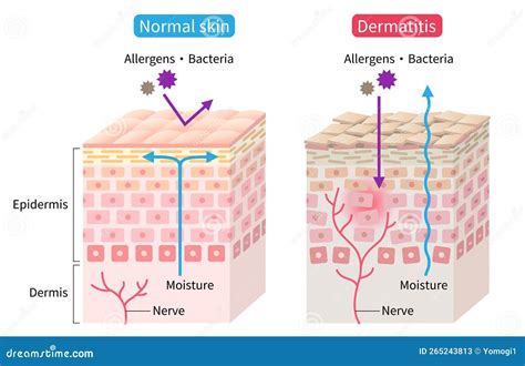 rappresentazione stilizzata della barriera cutanea sana contrapposta a quella con dermatite atopica
