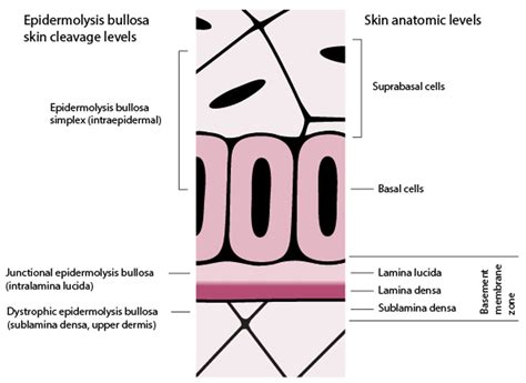 Schema dei livelli di clivaggio cutaneo nell'Epidermolisi Bollosa