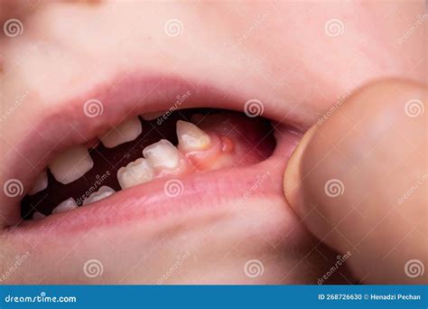 Child with swollen gums