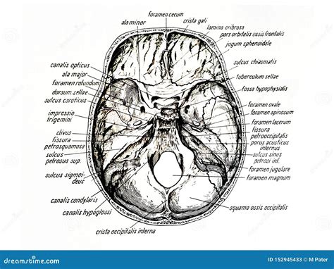Illustrazione di un foro cranico con segni di guarigione