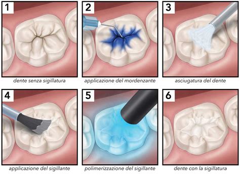 Fasi dell'applicazione del sigillante dentale
