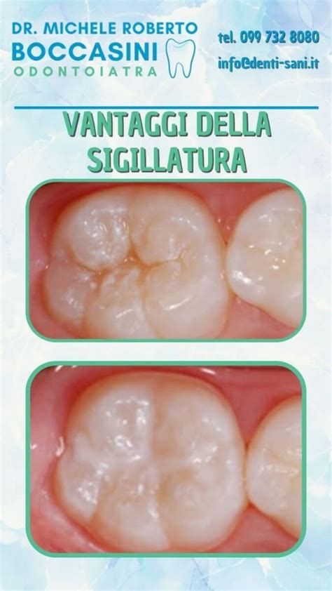Rischio di carie sotto sigillatura non corretta