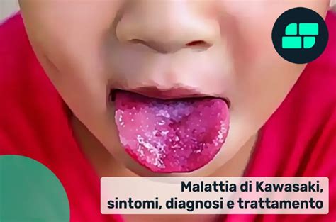 Sintomi Malattia di Kawasaki