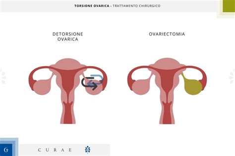 Illustrazione anatomica della torsione ovarica