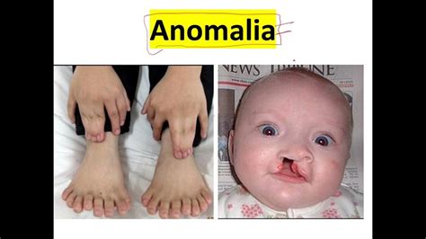 Differenza tra anomalia cromosomica e malformazione congenita