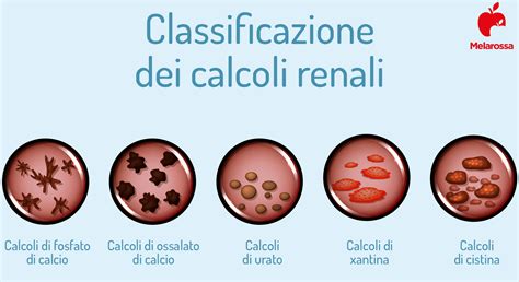 Tipi di calcoli renali