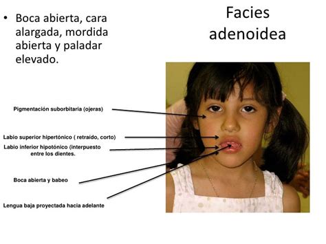 diagramma che mostra l'evoluzione della facies adenoidea in seguito alla respirazione orale cronica