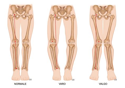rappresentazione schematica dell'allineamento delle gambe nel ginocchio valgo